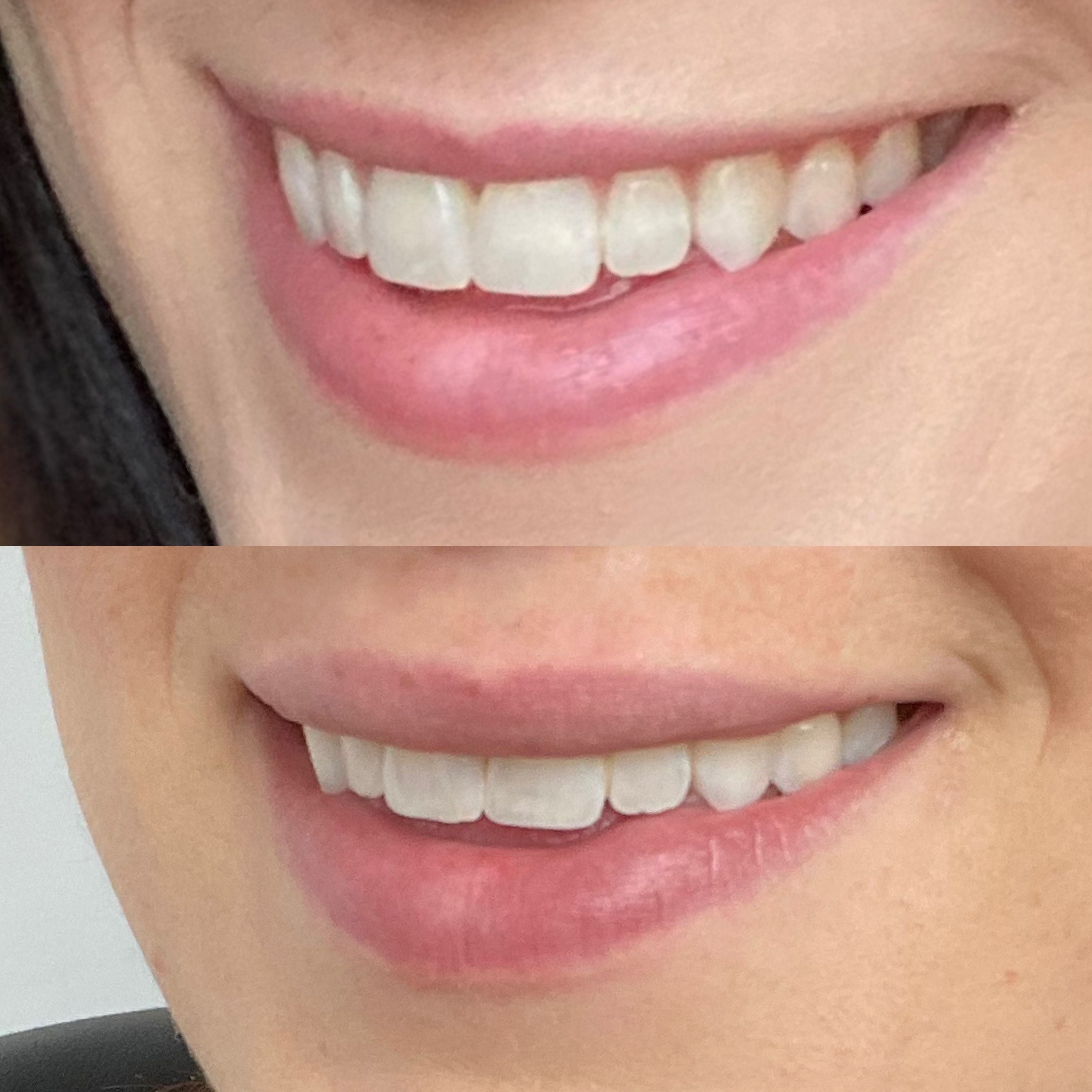 Lip filler or Lip flip ? Lip filler or Lip flip ?